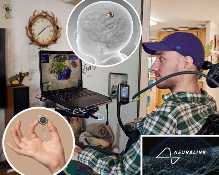 Fotografía de un hombre con discapacidad usando un implante cerebral de Neuralink para controlar una computadora portátil y jugar un videojuego, con ilustraciones que muestran el chip implantado y el logotipo de la empresa.